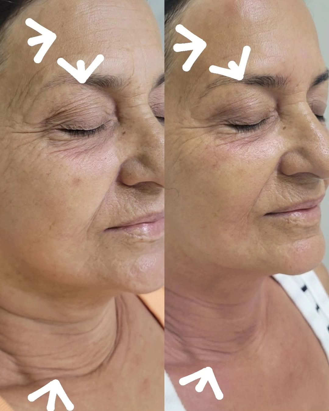 Antes e depois real de tratamento facial realizado na clínica