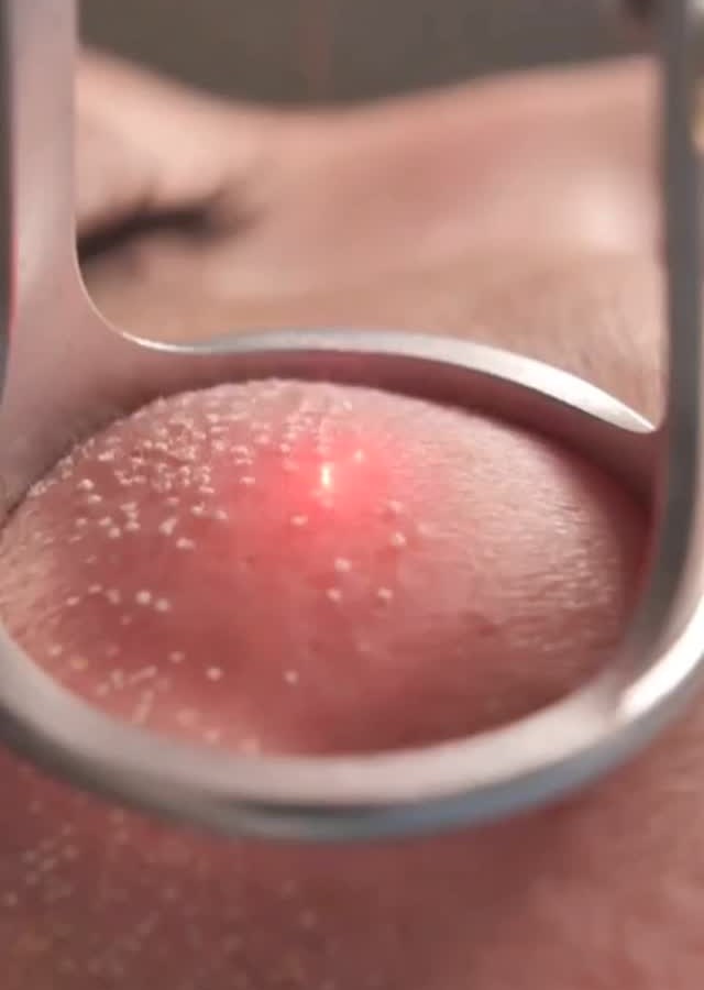 Close de laser em ação durante procedimento estético na clínica